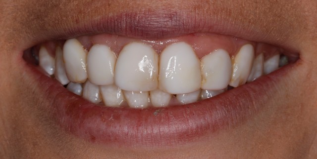 Patient presented with a poor example of direct composite veneers