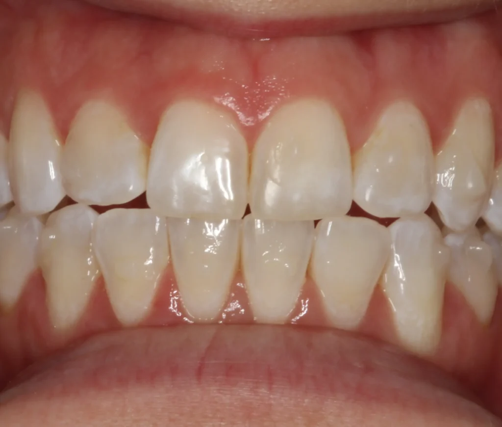 periodontitis