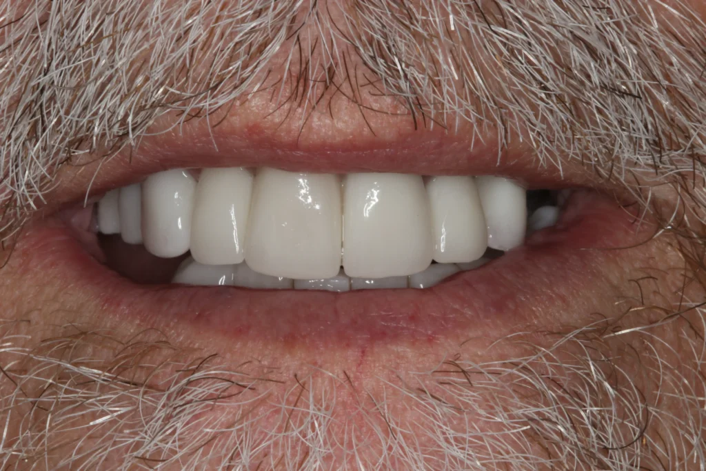 porcelain veneers