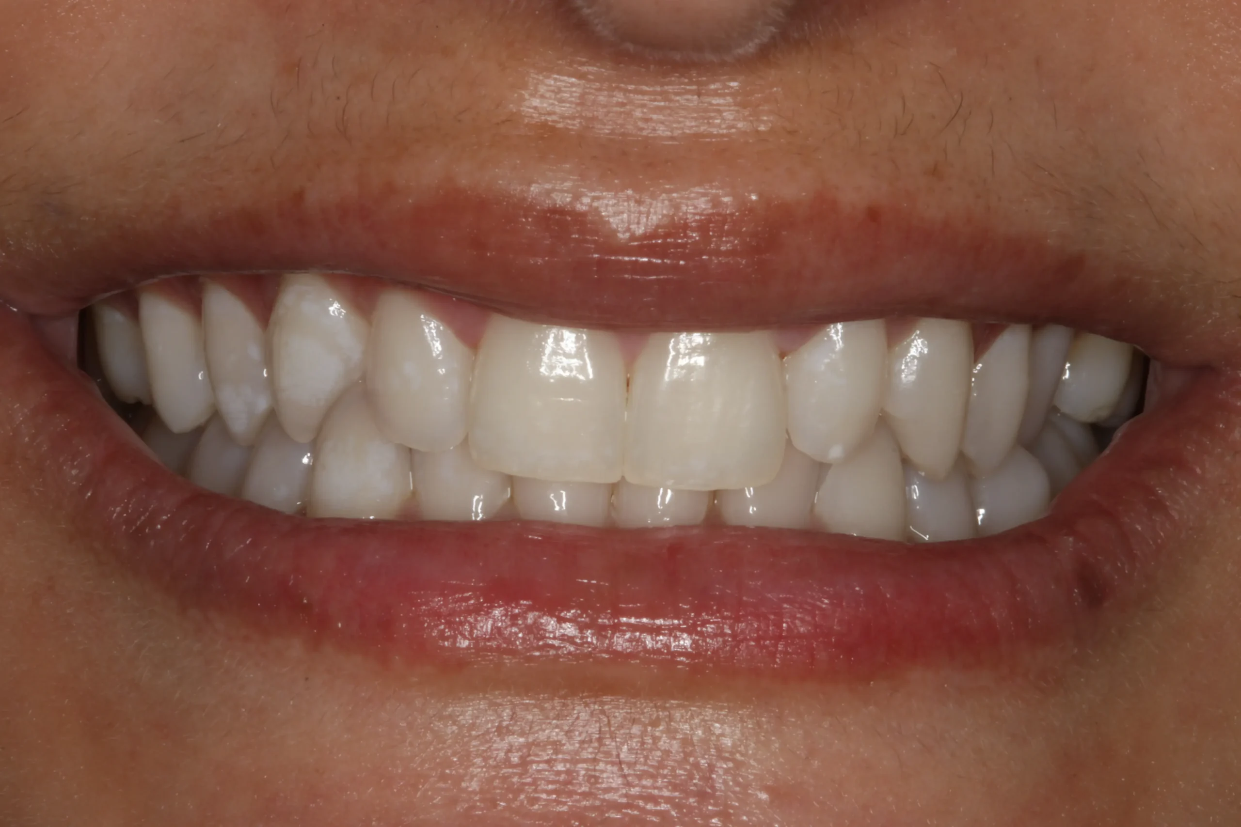 bonded veneers