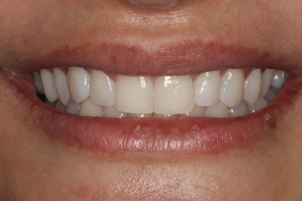 bonded veneers