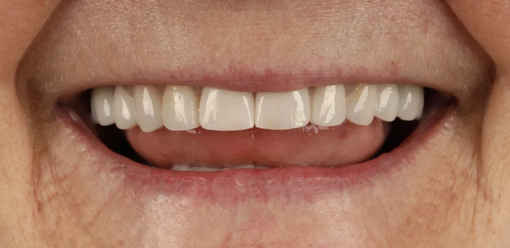 veneers