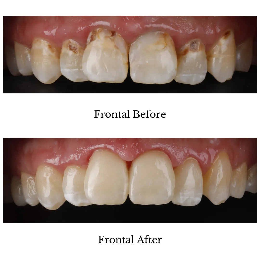 Composite Bonding