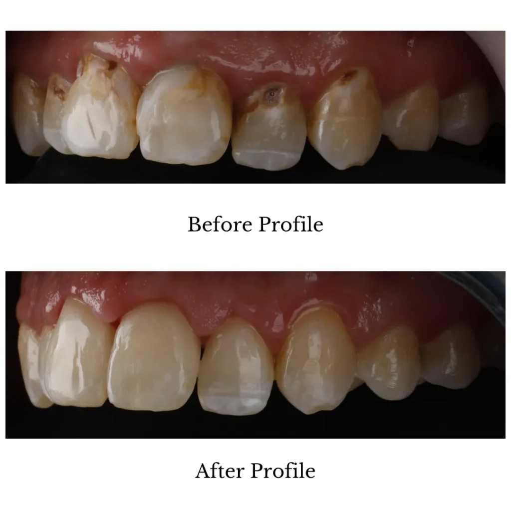 Direct Veneers